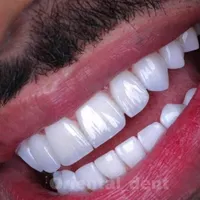 دندانپزشکی بدون پیش پرداخت عصب کشی . کامپوزیت و...|خدمات آرایشگری و زیبایی|قم, عمار یاسر|دیوار