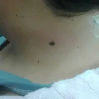 خال برداری|خدمات آرایشگری و زیبایی|ورامین, ورامین|دیوار