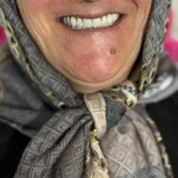 ساخت پروتز دندان (دندان مصنوعی)