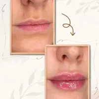 تزریق فیلر و بوتاکس توسط پزشک با تخفیف ویژه|خدمات آرایشگری و زیبایی|اراک, |دیوار