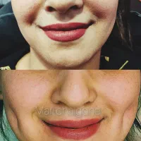 تزریق ژل بوتاکس چال گونه واموزش حرفه ای