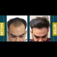 درمان ریزش مو