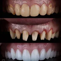 دندانپزشکی صدف (با شرایط اقساط) کامپوزیت|خدمات آرایشگری و زیبایی|قم, حقیقت|دیوار