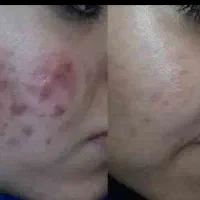 حذف دائمی تمامی جوش و جای جوش