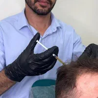 پی آر پی(prp) صورت مو بدن توسط پزشک با قیمت عالی|خدمات آرایشگری و زیبایی|اسلام‌شهر, باغ فیض|دیوار