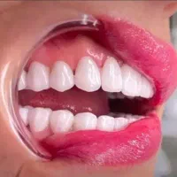 ‌کامپوزیت دندان ۱ م. عصب کشی ۱/۵ .ایمپلنت۲۰م