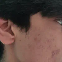 بهبود کبد چرب گرید 1.2.3