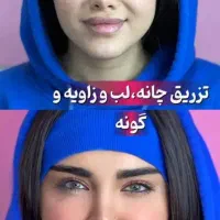 تزریق فیلر ۶۸۰ بوتاکس۷۵۰ .لیزر اقاوخانم