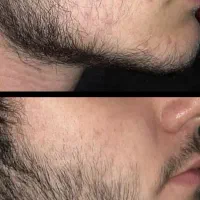آیا از کوتاه بودن ریش و سیبیل خود رنج میبرید