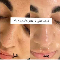 پیراپزشک طب سنتی متخصص پوست|خدمات آرایشگری و زیبایی|رشت, رودباری|دیوار