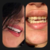 ایمپلنت و زیبایی دندان اقساط ۱۲ ماهه اکو دنتال|خدمات آرایشگری و زیبایی|تهران, خانی آباد نو شمالی|دیوار