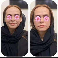 لیزر فول بادی تخفیف بمناسبت افتتاح شعبه جدید