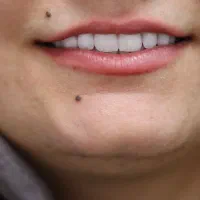 دندانپزشکی اقساطی بدون پیش پرداخت ایمپلنت کامپوزیت