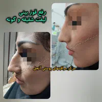 آنزیم ژل فیلر مزو بوتاکس فیشیال لابیا تنگی هودکتوم|خدمات آرایشگری و زیبایی|مشهد, آزادشهر|دیوار