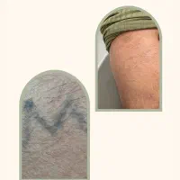 لیزر تتو با ضمانت