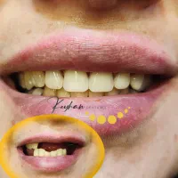 پروتز متحرک پارسیل (چهار تا هشت دندان)|خدمات زیبایی و سلامت|تهران, ائمه اطهار|دیوار