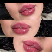 ژل فیلر بوتاکس گونه لب چانه و غیره ۱۸۰۰|خدمات آرایشگری و زیبایی|زاهدان, |دیوار