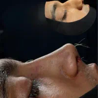 عمل جراحی زیبائی بینی|خدمات آرایشگری و زیبایی|قم, سالاریه|دیوار