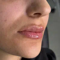 نیازمند مدل رایگان فیلر بوتاکس و prp کاشت نخ