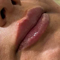 ژل لب،بوتاکس،زاویه سازی توسط پزشک|خدمات آرایشگری و زیبایی|تهران, صادقیه|دیوار