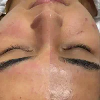 پاکسازی و فیشال تخصصی صورت قیمت ویژه