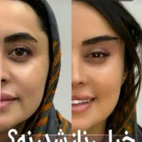 ساکشن شکم‌پهلوغبغب اندولیفت بلفارو|خدمات آرایشگری و زیبایی|شیراز, امام حسین|دیوار