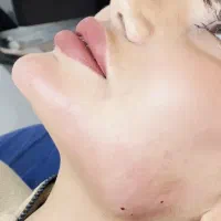 جشنواره بوتاکس مزوژل ژل فیلر لب چانه زاویه فک گونه