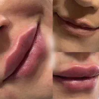 مدل ژل لب گونه چونه زاویه خط خنده ۴۰۰ ت|خدمات آرایشگری و زیبایی|قم, تولید دارو و یخچال|دیوار