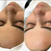 اصلاح درما + پاکسازی