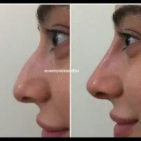 بمب تخفیف ژل ،بوتاکس،نخ وغیره فقط دوهفته لارم|خدمات آرایشگری و زیبایی|لار, |دیوار