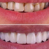 آف ویژه خدمات  کامل دندان پزشکی بدون پیش پرداخت