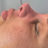 آف ویژه عمل جراحی زیبایی بینی /لیپوساکشن