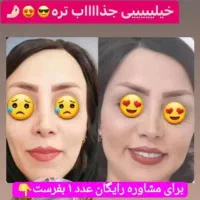 پک چاقی صورت