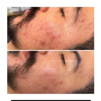 پاکسازی تخصصی پوست آقایان (کاشمر)|خدمات آرایشگری و زیبایی|کاشمر, |دیوار