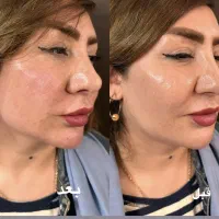 تزریق ژل و بوتاکس هایفو مزو پی ار پی ۸۹۹|خدمات زیبایی و سلامت|تهران, شکوفه (عبدل آباد)|دیوار