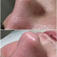 فشیال/پاکسازی تخصصی پوست