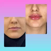 بوتاکس،لیزر،ژل،نخ گذاری و هایفودکتر شهبازی|خدمات آرایشگری و زیبایی|یزد, |دیوار