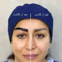 جشنواره پاییزی کاشت مو وابرو