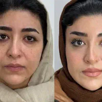 بوتاکس مصپورت