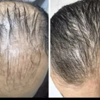 با محصول اکسونیک، کم پشتی و ریزش. موهاتو برطرف کن