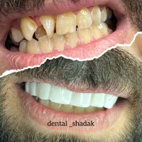 خدمات کامپوزیت مدت محدود|خدمات آرایشگری و زیبایی|اهواز, زیباشهر|دیوار
