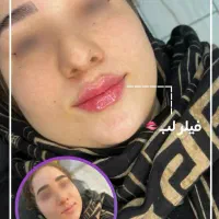 لیزر پی ار پی ژل فیلر بوتاکس لیفت نخ پی ارپی prp