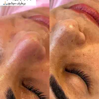 پاکسازی تخصصی پوست و لیفت ابرو روسی|خدمات آرایشگری و زیبایی|تنکابن, |دیوار