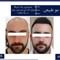 کاشت مو و ابرو طبیعی|خدمات آرایشگری و زیبایی|اصفهان, شاهزید|دیوار