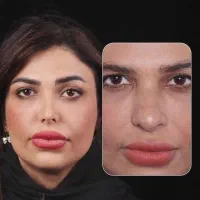 عمل بینی توسط متخصص به قیمت ۱۴۰۴