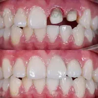روکش دندان با تخفیف ویژه (دندان‌های ۱ تا ۵)