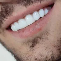 لمینت مترحک دندان اصل|آرایشی، بهداشتی، درمانی|ایلام, |دیوار