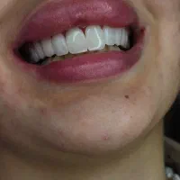 دندانپزشکی باتعرفه دولتی عصب‌کشی کامپوزیت|خدمات آرایشگری و زیبایی|تهران, تهرانپارس غربی|دیوار