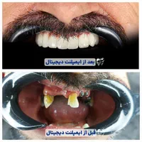 ایمپلنت و لمینیت و کامپوزیت دیجیتال بدون تراش|خدمات آرایشگری و زیبایی|شیراز, نیایش|دیوار