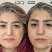 هایفو صورت و واژینال با دقت هوش مصنوعی افر تافردا|خدمات آرایشگری و زیبایی|مشهد, آزادشهر|دیوار